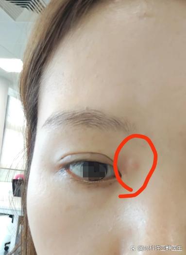 眼角有个凸起的小疙瘩
