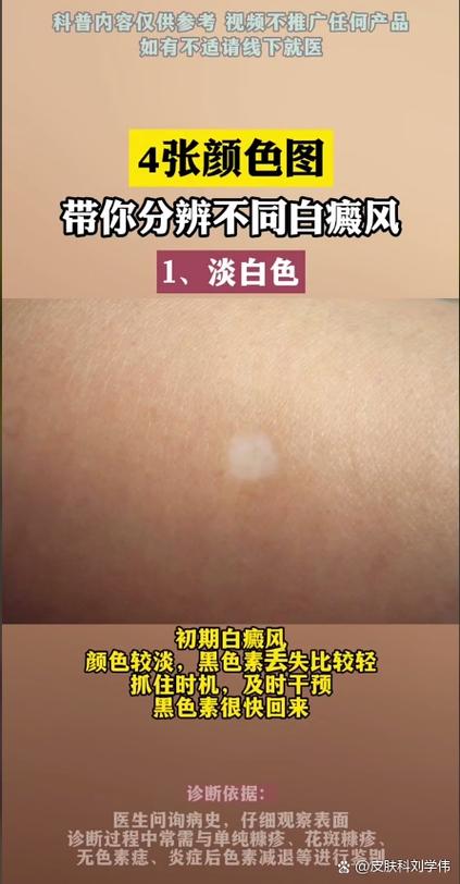 白斑会自己消失吗缩略图