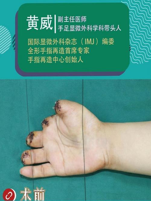 手指再造后2年后就废了吗