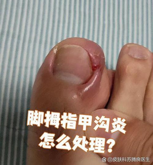 甲沟炎修脚有用吗