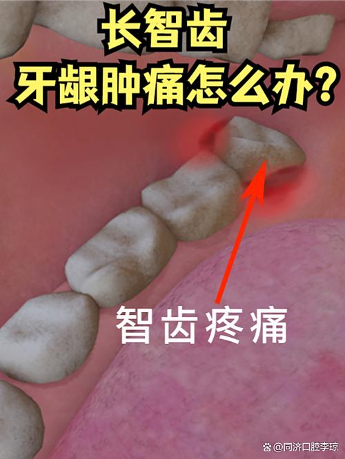 牙龈肿了大包如何消肿缩略图