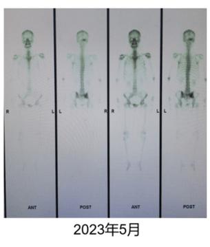 骨扫描报告单怎么提示转移