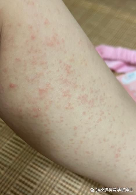 海鲜过敏图片