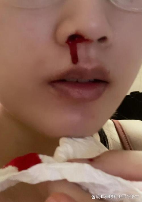 看美女为什么会流鼻血