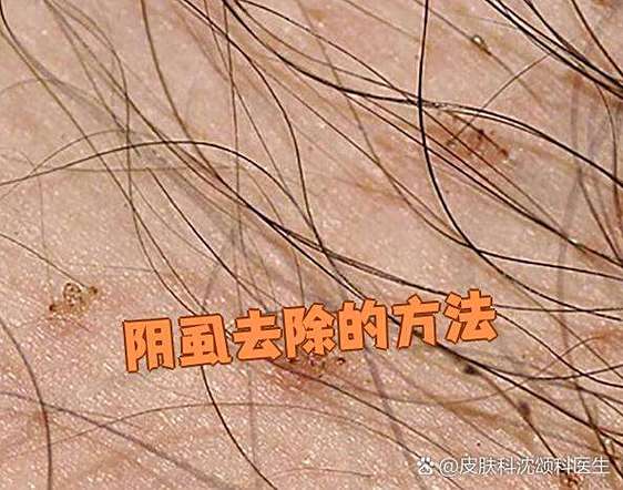 毛上有阴虱怎么去除