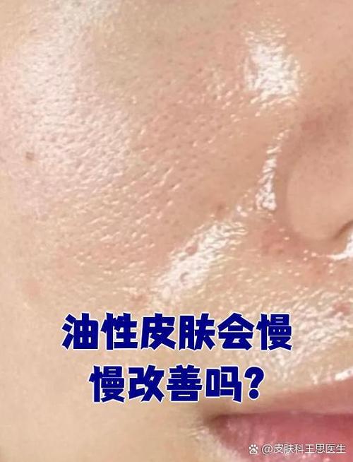 油脸能彻底改善吗