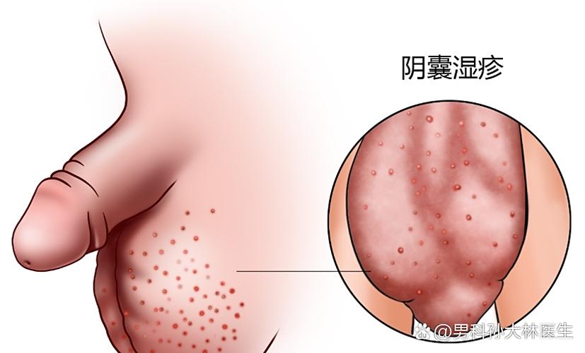 阴囊有一股腥臭味还潮湿