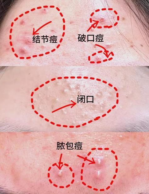 用口水擦痘痘会怎么样