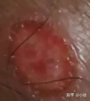 丁丁硬下疳照片图标