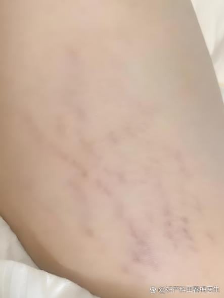 妈妈纹怎么去除