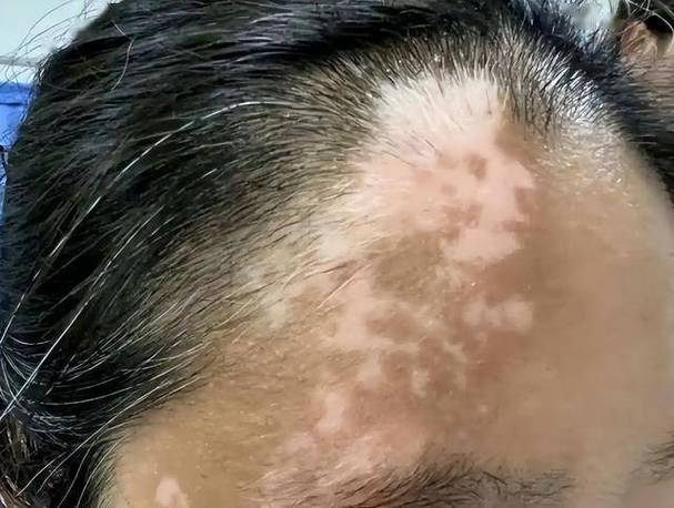 为什么突然得白癜风