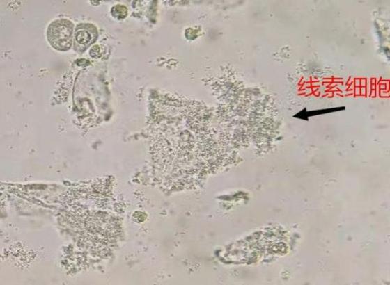 什么叫线索细胞