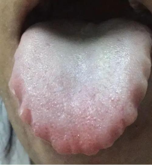 哑巴的舌头什么症状