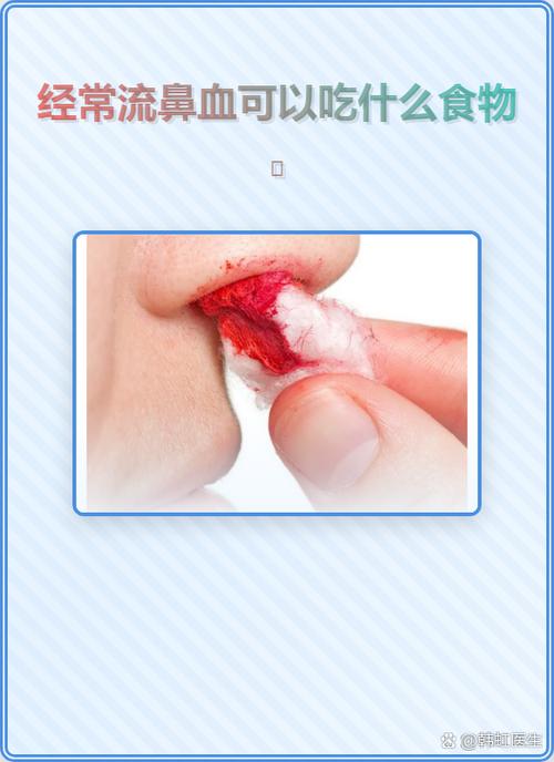 经常流鼻血吃什么好缩略图