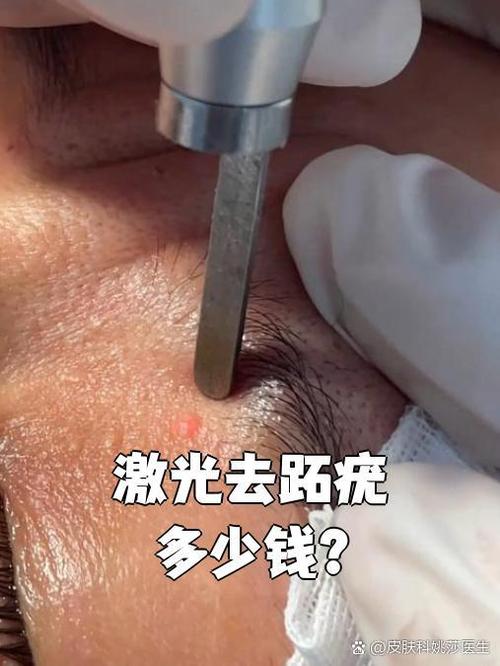 皮肤科做一次激光多少钱