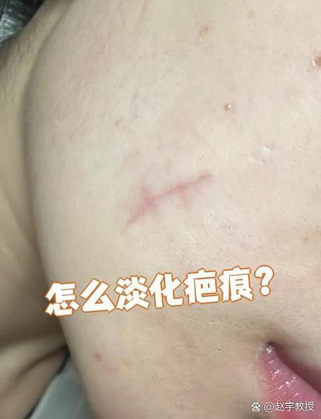 脸上有疤印用什么淡化