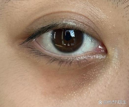 黑眼圈很重怎么去除