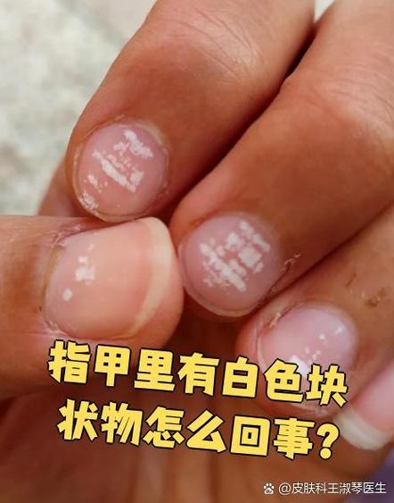指甲里面突然白了一块