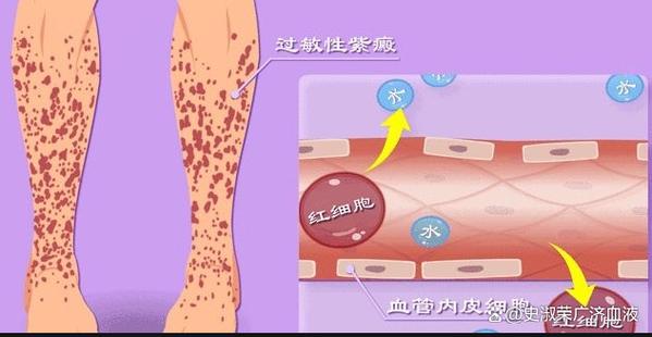 紫色斑点的形成原因