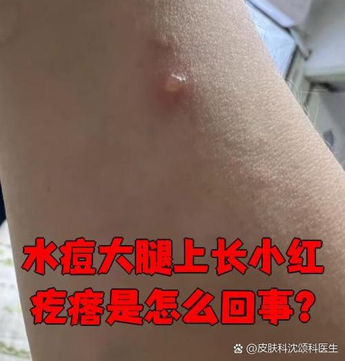 这是什么皮肤病缩略图