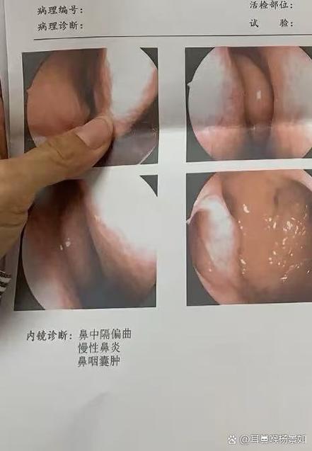 鼻子老是流鼻血是什么原因