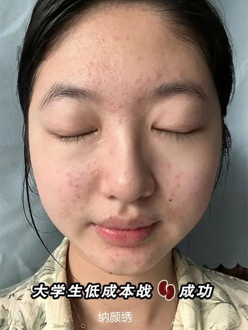 女生说自己长痘了怎么回复