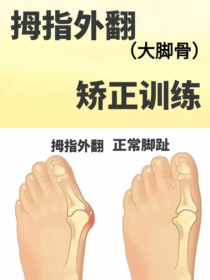 拇外翻如何自己矫正
