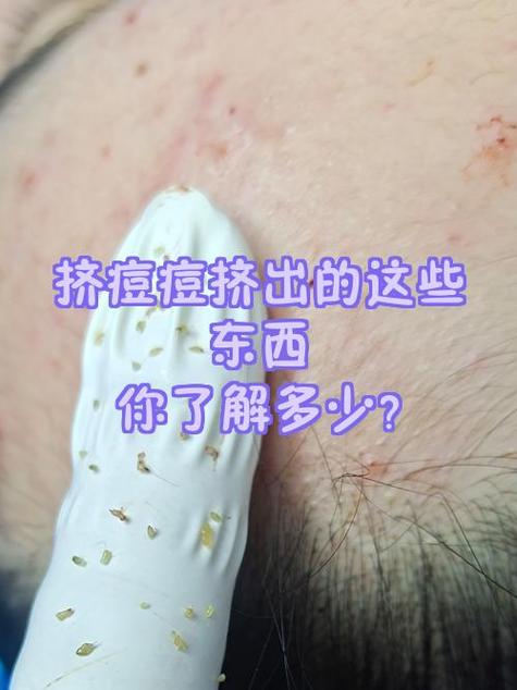 痘痘能挤吗