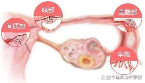 输卵管不通畅怎么办如何治疗