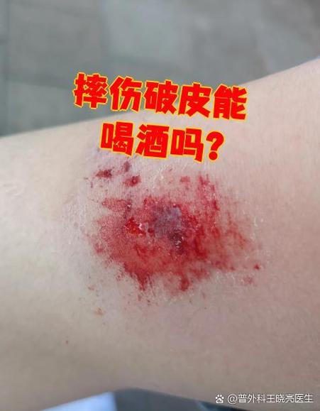 酒后自己摔伤谁负责
