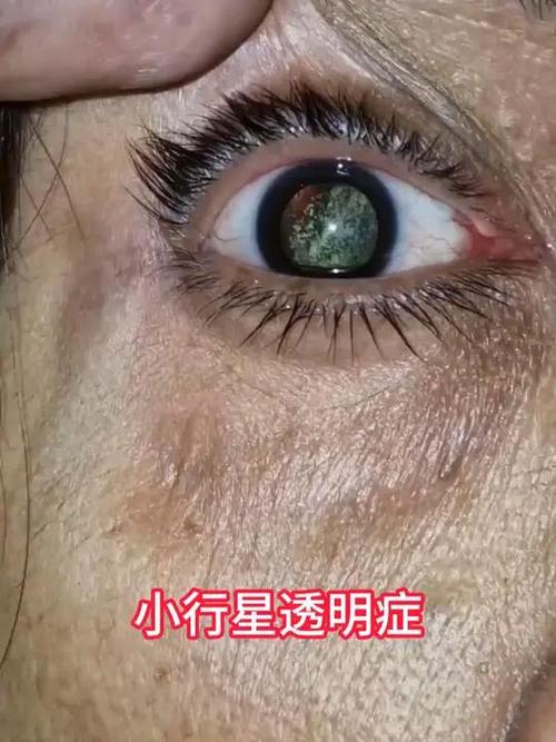 眼睛里有透明小圆圈
