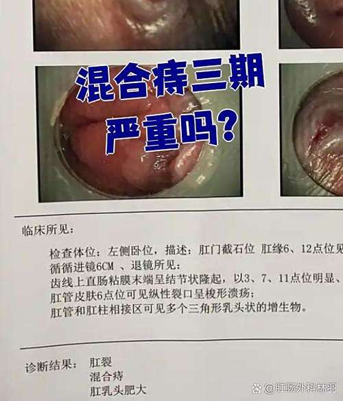 痔疮外痔肉球怎么消除
