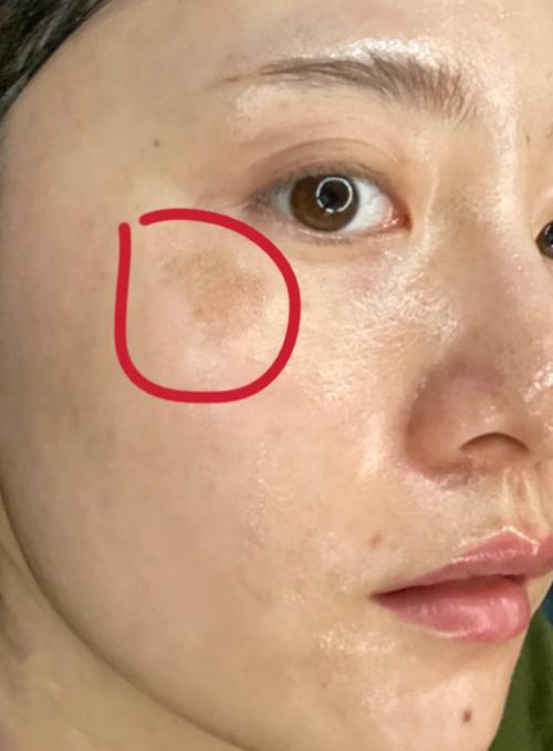 激光祛斑三天后的照片