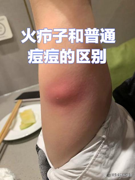 红肿硬痘痘,按着疼,怎么尽快消