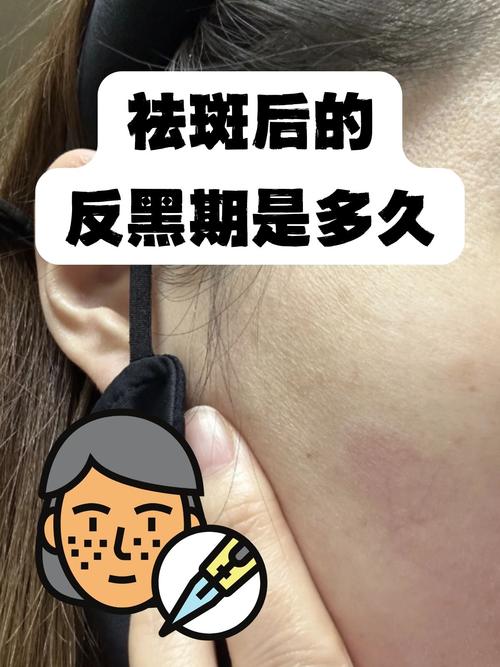 苹果手机摄像头有黑斑怎么办