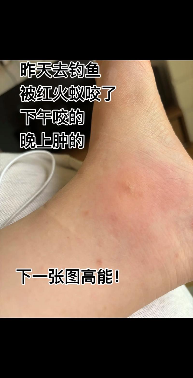 被蚂蚁咬了会怎么样