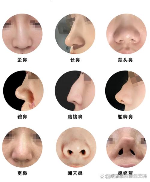 鼻子有几种鼻型