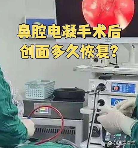 流鼻血电凝手术多少钱