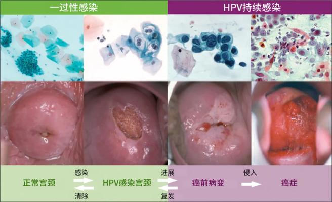 女性hpv感染是什么原因引起的