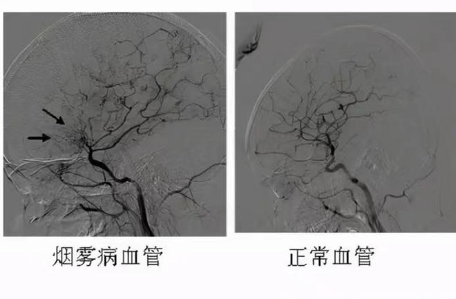 烟雾病专家排名第一名