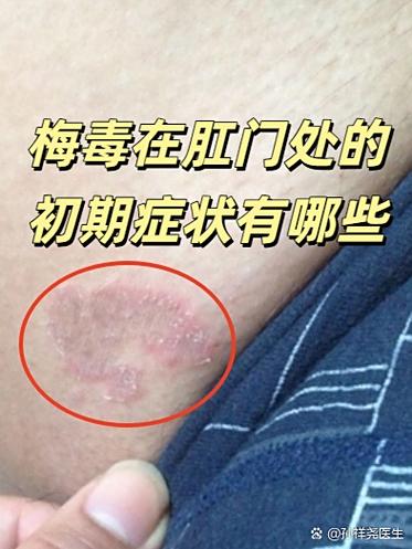 性疾病感染几天出现症状缩略图