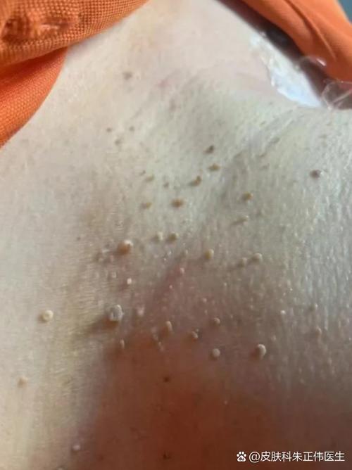 hpv乳头状图片