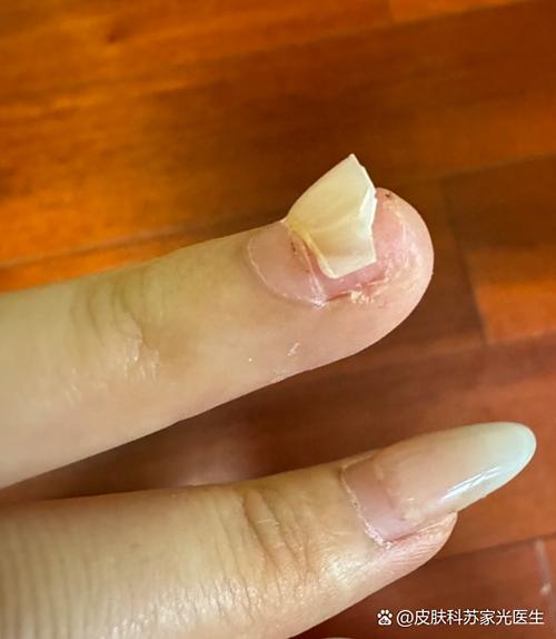 脚趾甲整个脱落为什么