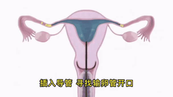 输卵管堵塞怎么办才能疏通