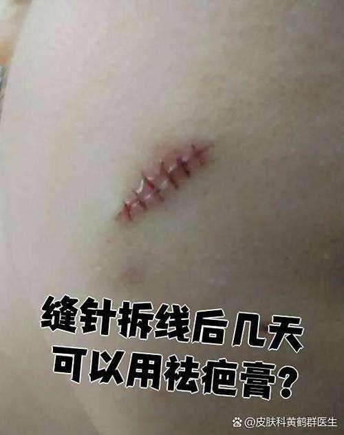 缝合后的伤疤最佳除疤时间