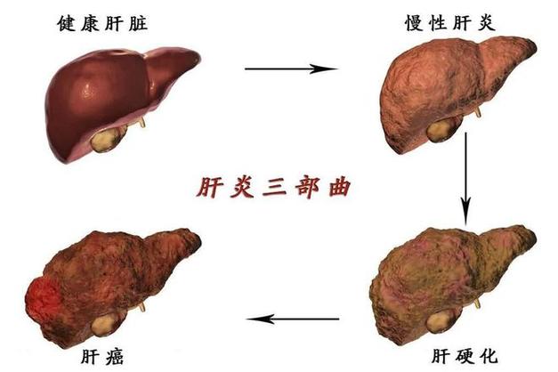 女人得了乙肝有啥表现