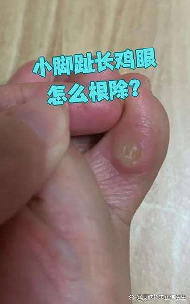脚上有肉刺怎么治疗能根除