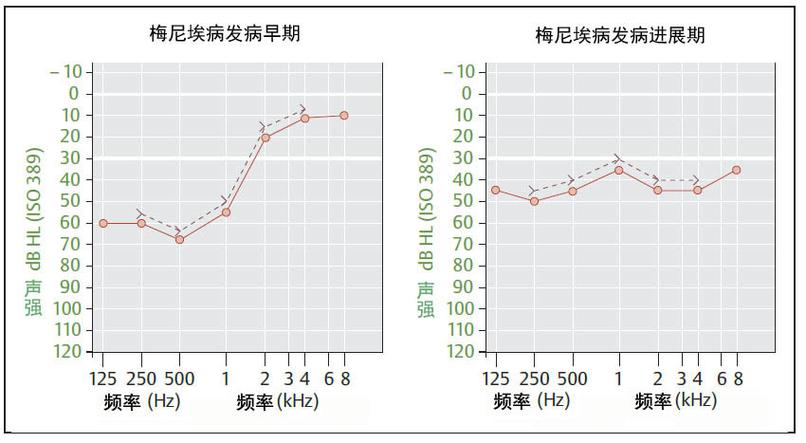 梅尼埃病是什么病