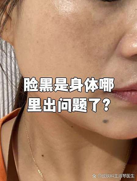 皮肤慢慢变黑是哪里出了问题