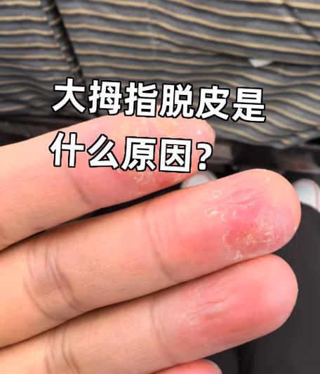 大拇指气泡蜕皮的原因